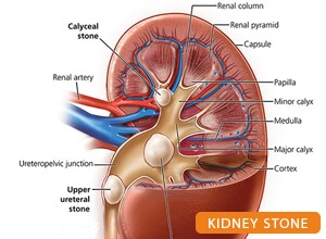 Kidney Stone Surgery in Patna