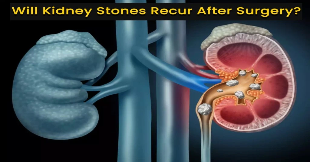 Kidney Stone Clinic in Patna