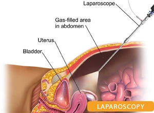 kidney-stone